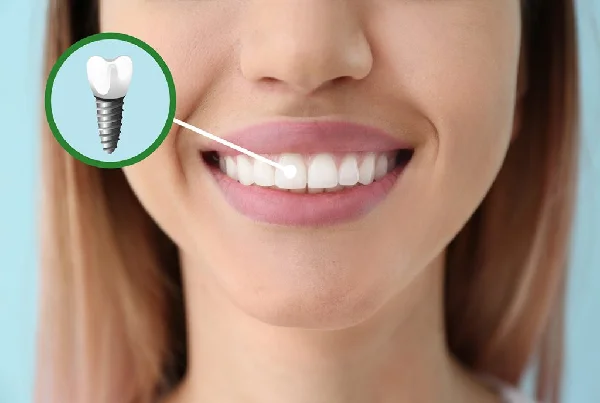 Dental Implants